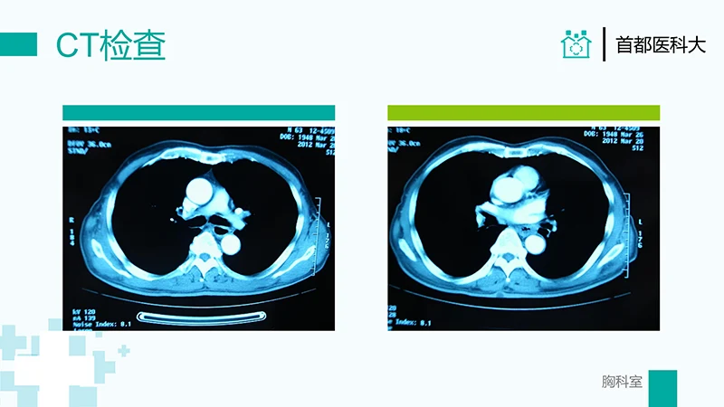 胸外科病例汇报PPT演示文稿免费下载免费PPT