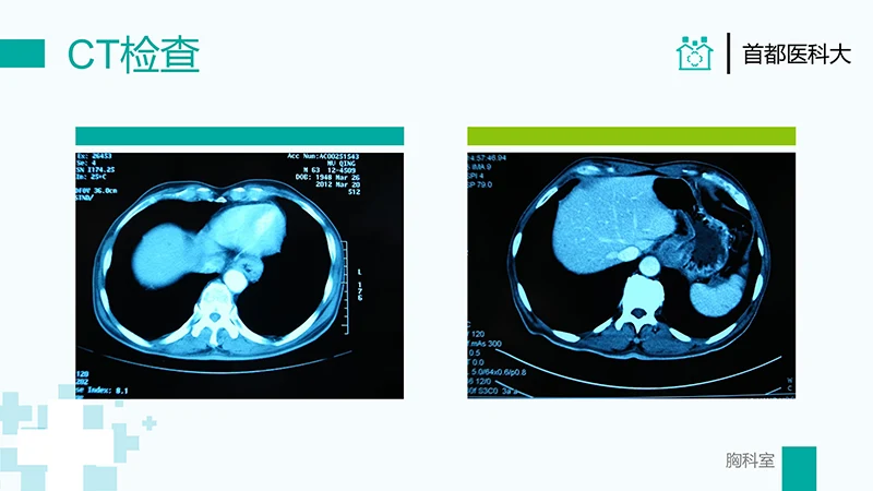 胸外科病例汇报PPT演示文稿免费下载免费PPT