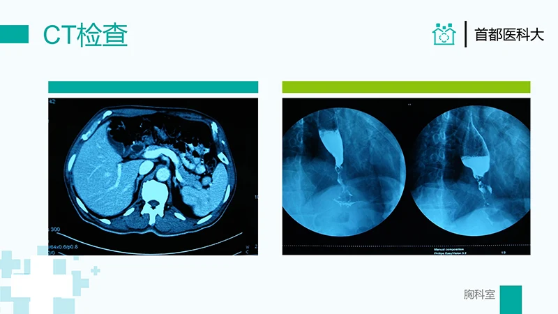 胸外科病例汇报PPT演示文稿免费下载免费PPT