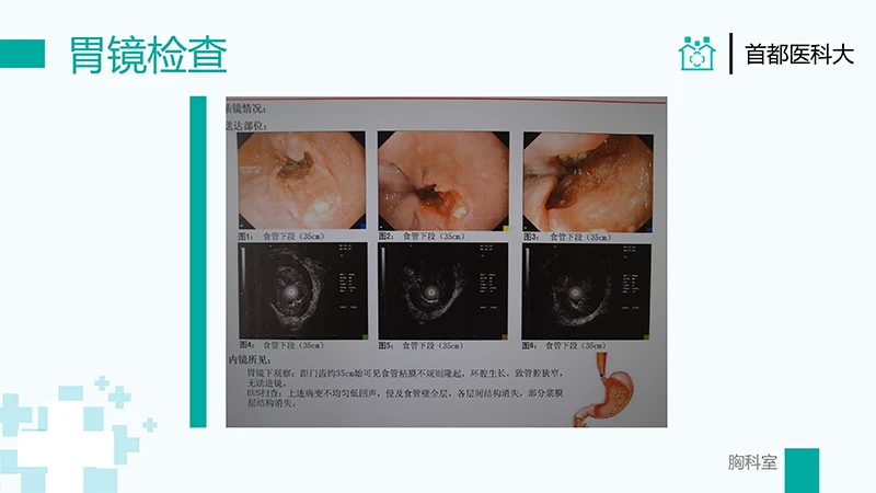 胸外科病例汇报PPT演示文稿免费下载免费PPT