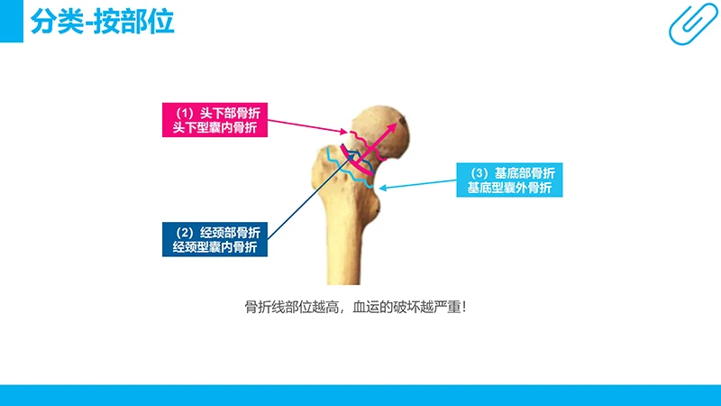 股骨颈骨折病例分析演示文稿免费下载免费PPT