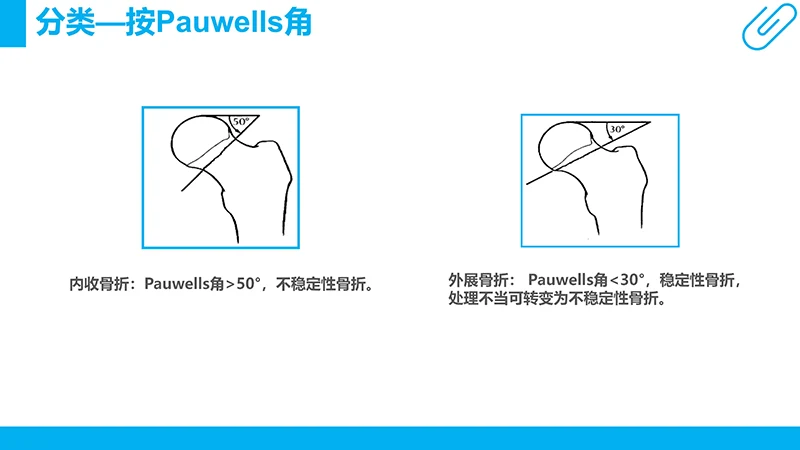 股骨颈骨折病例分析演示文稿免费下载免费PPT
