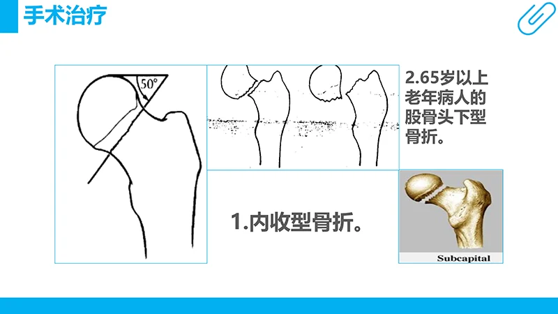 股骨颈骨折病例分析演示文稿免费下载免费PPT