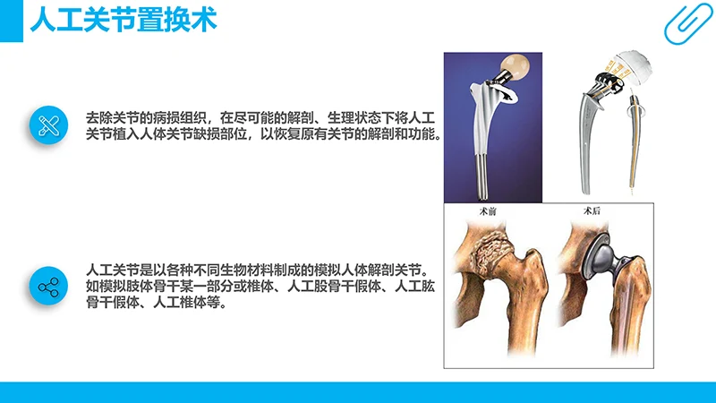股骨颈骨折病例分析演示文稿免费下载免费PPT