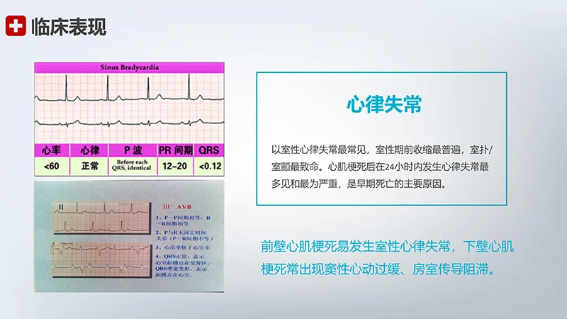 急性心梗护理查房ppt模板免费下载免费PPT