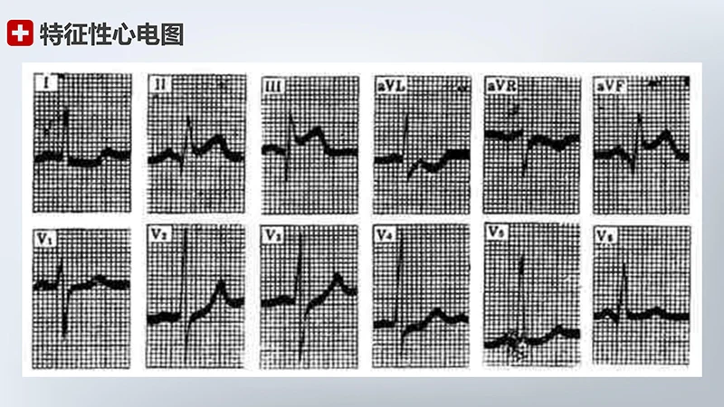 急性心梗护理查房ppt模板免费下载免费PPT