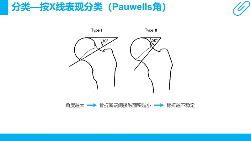 股骨颈骨折护理查房ppt演示文档免费下载免费PPT