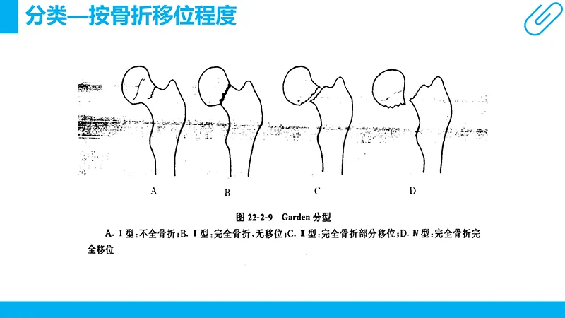 股骨颈骨折护理查房ppt演示文档免费下载免费PPT