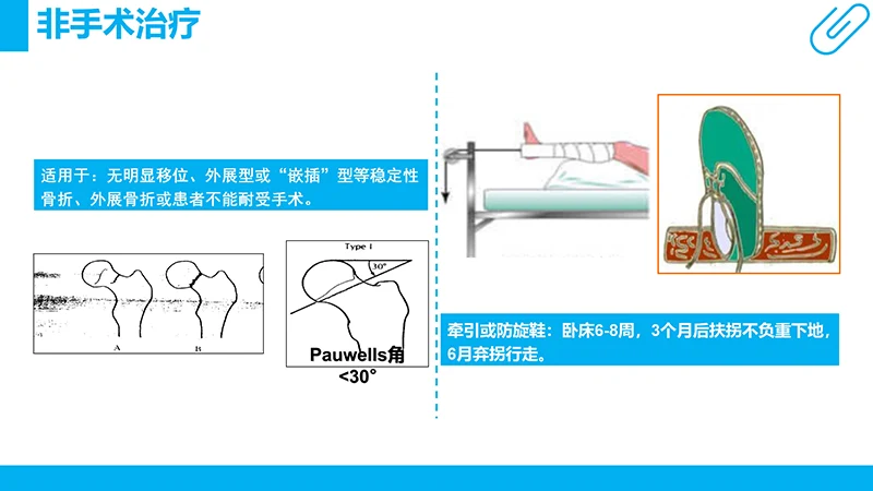 股骨颈骨折护理查房ppt演示文档免费下载免费PPT