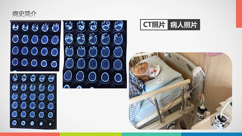 亚急性硬膜下血肿护理查房ppt演示文档免费下载免费PPT