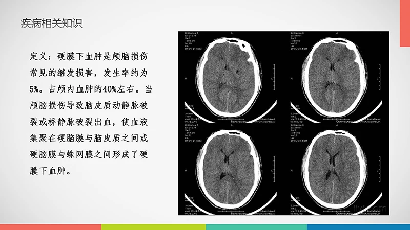 亚急性硬膜下血肿护理查房ppt演示文档免费下载免费PPT