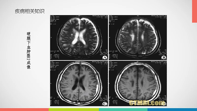 亚急性硬膜下血肿护理查房ppt演示文档免费下载免费PPT