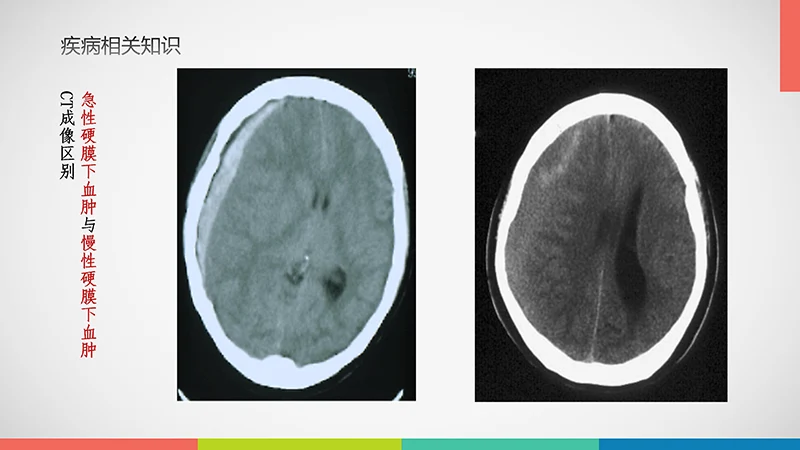 亚急性硬膜下血肿护理查房ppt演示文档免费下载免费PPT