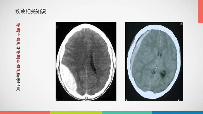 亚急性硬膜下血肿护理查房ppt演示文档免费下载免费PPT