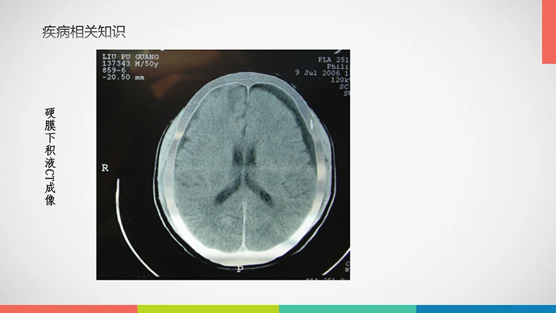 亚急性硬膜下血肿护理查房ppt演示文档免费下载免费PPT