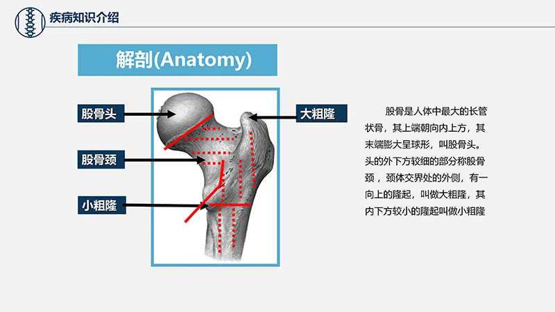 关注病人健康股骨颈骨折护理查房ppt演示文档免费下载免费PPT