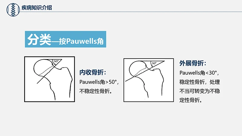 关注病人健康股骨颈骨折护理查房ppt演示文档免费下载免费PPT