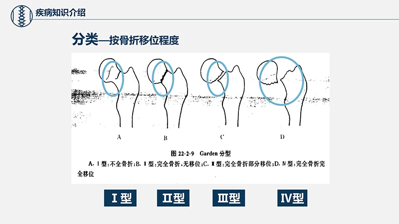 关注病人健康股骨颈骨折护理查房ppt演示文档免费下载免费PPT