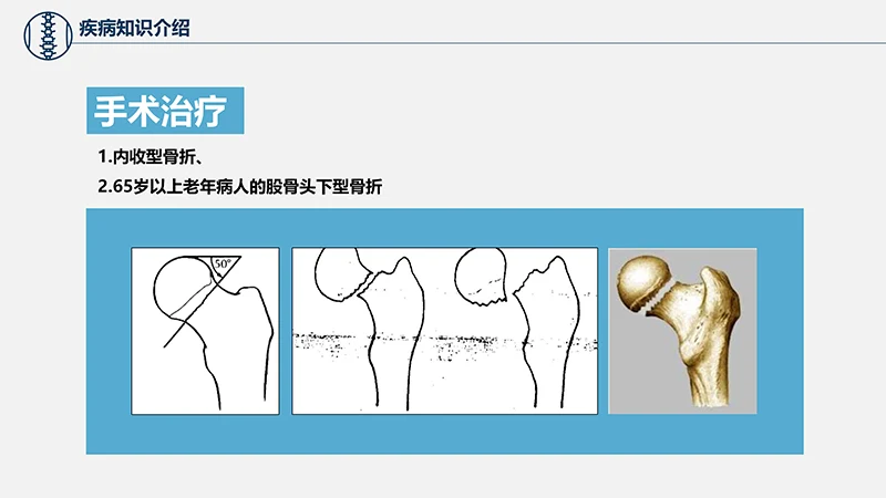 关注病人健康股骨颈骨折护理查房ppt演示文档免费下载免费PPT
