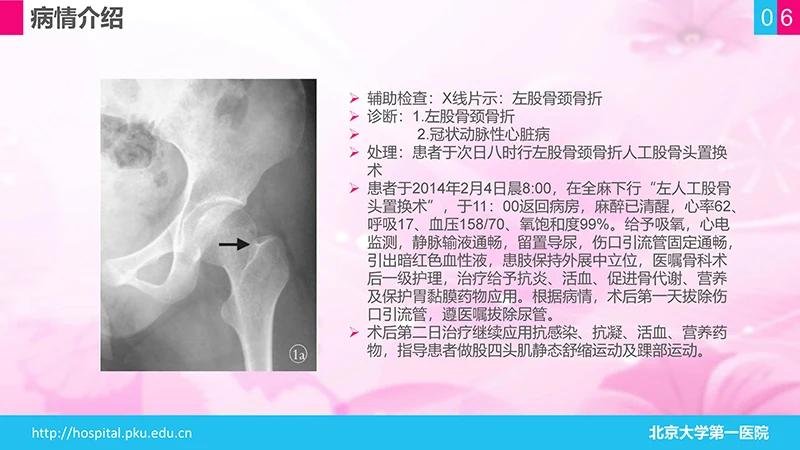 股骨颈骨折护理查房ppt演示文档免费下载免费PPT