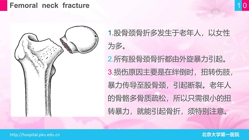 股骨颈骨折护理查房ppt演示文档免费下载免费PPT