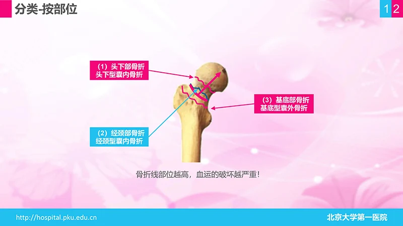 股骨颈骨折护理查房ppt演示文档免费下载免费PPT