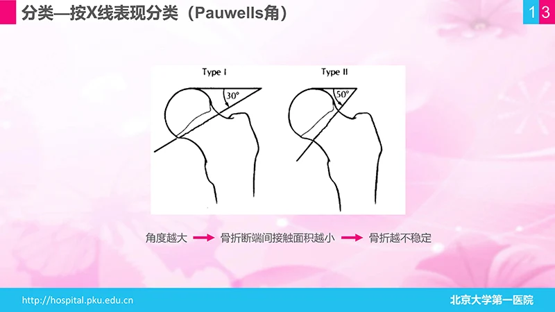 股骨颈骨折护理查房ppt演示文档免费下载免费PPT