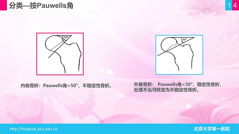 股骨颈骨折护理查房ppt演示文档免费下载免费PPT