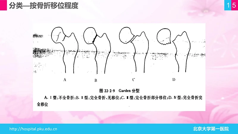 股骨颈骨折护理查房ppt演示文档免费下载免费PPT