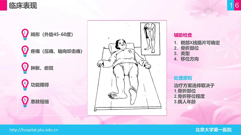 股骨颈骨折护理查房ppt演示文档免费下载免费PPT