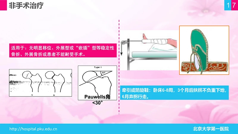 股骨颈骨折护理查房ppt演示文档免费下载免费PPT