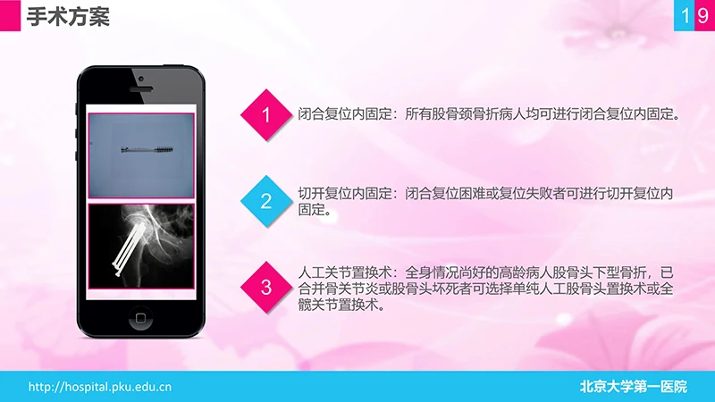 股骨颈骨折护理查房ppt演示文档免费下载免费PPT